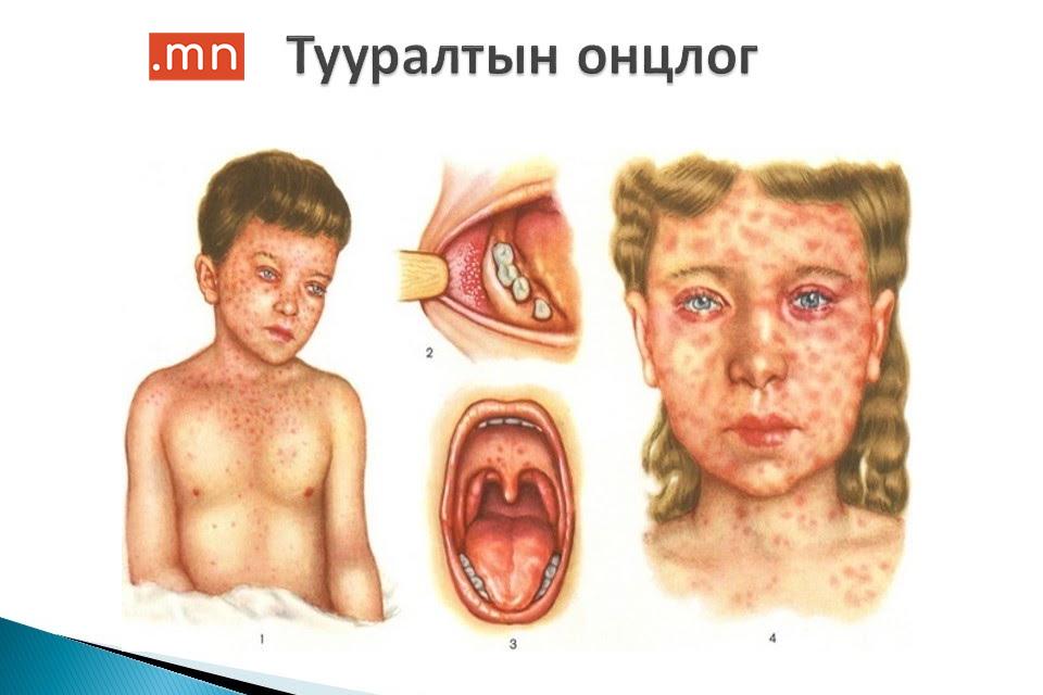 УЛААНБУРХАН ӨВЧНИЙ ДЭГДЭЛТИЙН ХАРИУ АРГА ХЭМЖЭЭ АВЧ АЖИЛЛАХЫГ ҮҮРЭГ БОЛГОЛОО